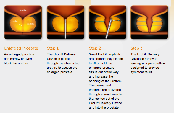 Urolift Graphic of Enlarged Prostate and Three Steps of Delivery, Implants, and Removal of Device